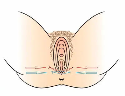 Малоинвазивная перинеопластика Vaginal Narrower, перинеовагинальный лифтинг  - Фарм БСК