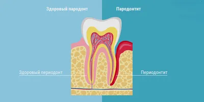 Периодонтит зуба — симптомы, виды, причины возникновения | Как лечить  периодонтит?