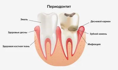 Периодонтит - что это, осложнения, лечение -