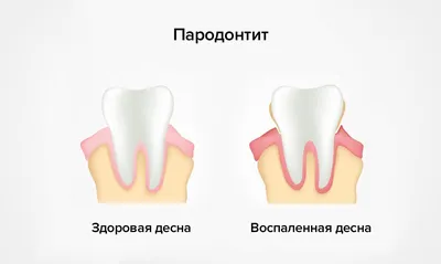 🦷Периодонтит зуба: цена лечения в Москве