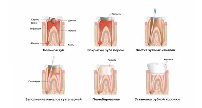 Периодонтит и его лечение - стоматология Мастер клиник в г.Бресте