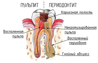 Периодонтит – Dental Clinic