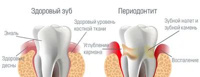 Периодонтит. Что это? Как и почему появляется? Симптомы. Лечение. Цены.