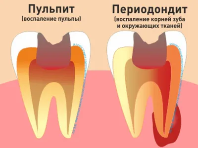 Что такое периодонтит, его лечение и профилактика - симптомы периодонтита
