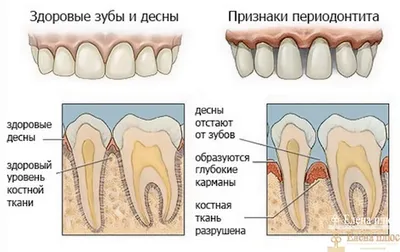 Хронический периодонтит зубов: причины, симптомы и лечение