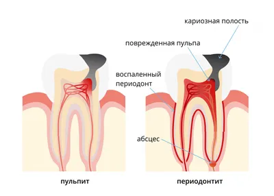 Лечение периодонтита в Симферополе