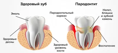Периодонтит - что это, осложнения, лечение -