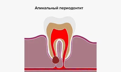 Периодонтит: причины, симптомы, методы диагностики и лечения периодонтита