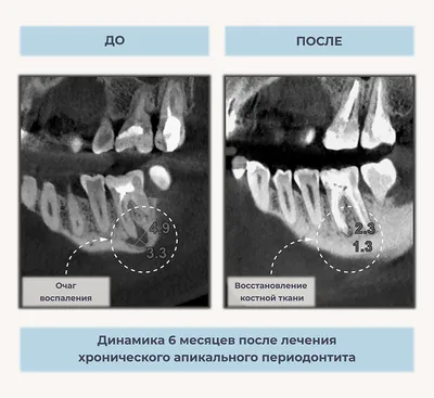 Гранулематозный периодонтит | Симптомы, лечение, профилактика | Клиника  семейной стоматологии Дока-Дент