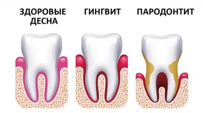 Периодонтит – что это и как его избежать. Рассказывают врачи-стоматологи. |  New York Dental Center | Дзен