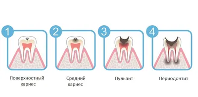 Периодонтит: виды и лечение у взрослых и детей