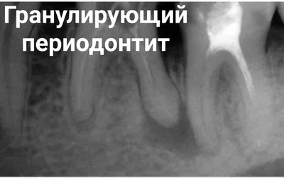 Лечение периодонтита у детей