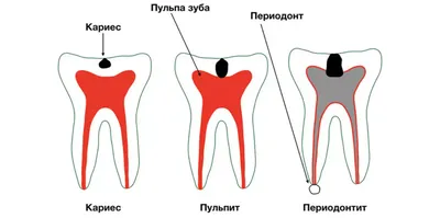 Периодонтит — DENTAKS | ДЕНТАКС