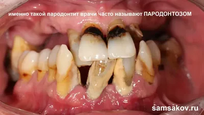 🦷Периодонтит зуба: цена лечения в Москве