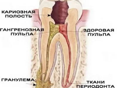 Отличия пародонтоза и пародонтита – клиника МАЙ