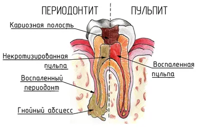 Гранулирующий периодонтит - признаки, причины, симптомы, лечение и  профилактика - iDoctor.kz