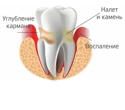 Периодонтит - что это, осложнения, лечение -