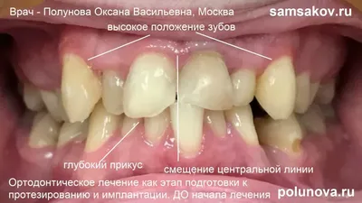 Что такое пародонтоз и как с ним справиться? (Ответы стоматолога) | OxiDen  | Стоматология Закревского 103