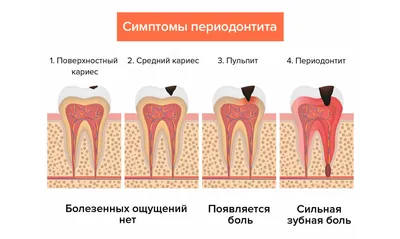 Периодонтит и пародонтит — Клиника \"Арбаль\" на Дмитрия Донского