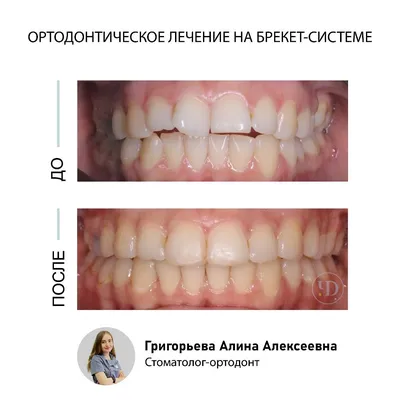 Лечение периодонтита. Кейс № 3 : фото до и после | Стоматология в СПб  «Чистое Дыхание»