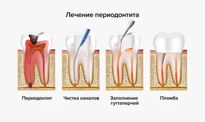 Периодонтит фото до и после фотографии