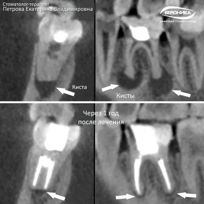 Киста зуба - показание к удалению? – Вероника