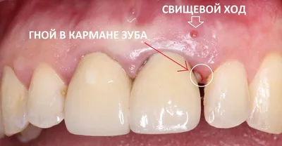 Лечение периодонтита. Екатеринбург, Стоматологическая клиника Дента Ви