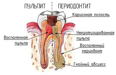Лечение периодонтита зуба в Минске, цена комплексного лечения каналов  периодонтита