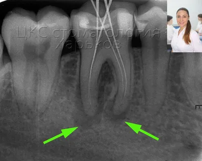 Лечение периодонтита в ЦКС. Харьков