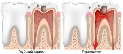 Периодонтит: Лечение периодонтита зуба в Киеве - цена в 32Dent