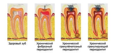 Лечение каналов зуба при периодонтите - Diamond Dent