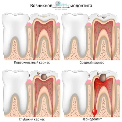 Лечение острого периодонтита зубов в стоматологии - цены в Москве