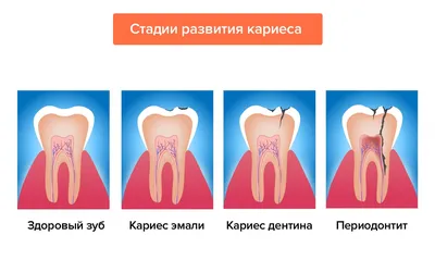 Лечение периодонтита — консервативные и хирургические методы