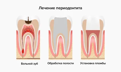 Периодонтит - что это, осложнения, лечение -