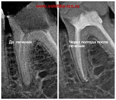 🦷Периодонтит зуба: цена лечения в Москве