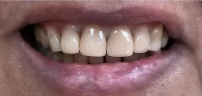 Raffa-Dent - ДО И ПОСЛЕ 💥⠀ ⠀ У пациентки хронический апикальный периодонтит  12, 11з.⠀ Кариозные полости находятся под десной на 2 мм.⠀ В 13 зубе  медиальной и дистальной полости( между 11 и