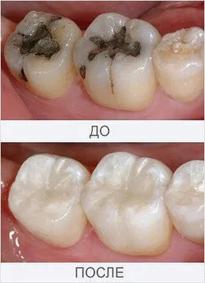 Реставрация 37, 38 зубов фото до после лечения пациента | стоматология  Эксперт