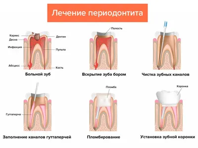 Хронический пародонтит - Cтоматология Май