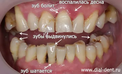 Что такое периодонтит и как с ним справляться