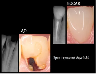 Периодонтит Зуба Лечение Киев На Рентгене ЛюмиДент