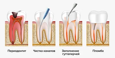 Лечение кариеса, пульпита, периодонтита