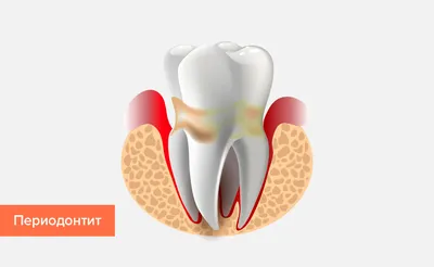 Лечение периодонтита