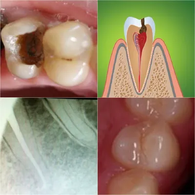 Лечение зубов — кариес, пульпит, периодонтит, описание и цены