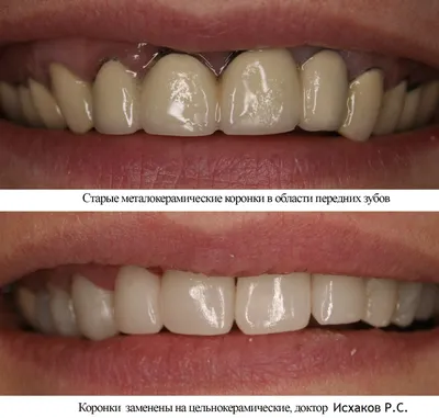 Локализованный пародонтит — диагностика и лечение в статье на Startsmile.ru