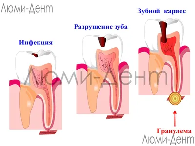 Периодонтит молочных зубов у детей — 5 специфических симптомов, 2 вида  лечения