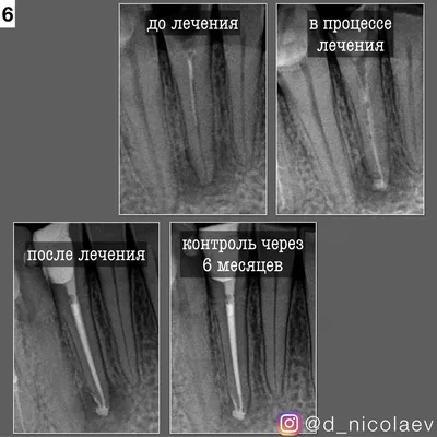 Что такое периодонтит - Доказательная медицина для всех