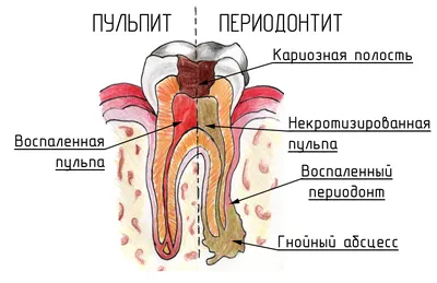 Что такое Периодонтит | Стоматология \"Эталон\"