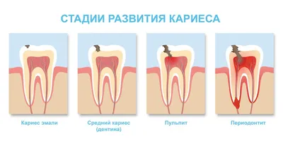 Апикальный периодонтит: лечение в стоматологии SILK