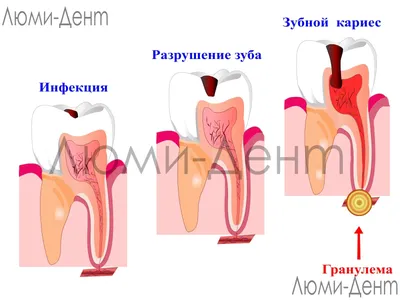 Периодонтит Зуба Лечение Киев На Рентген Снимке ЛюмиДент