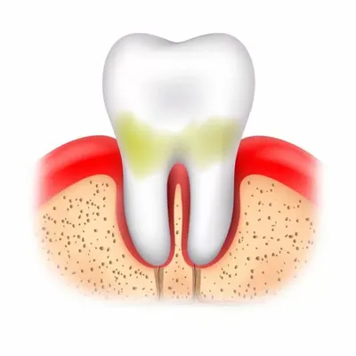 Лечение гранулематозного периодонтита зубов в Люберцах цена, отзывы, фото